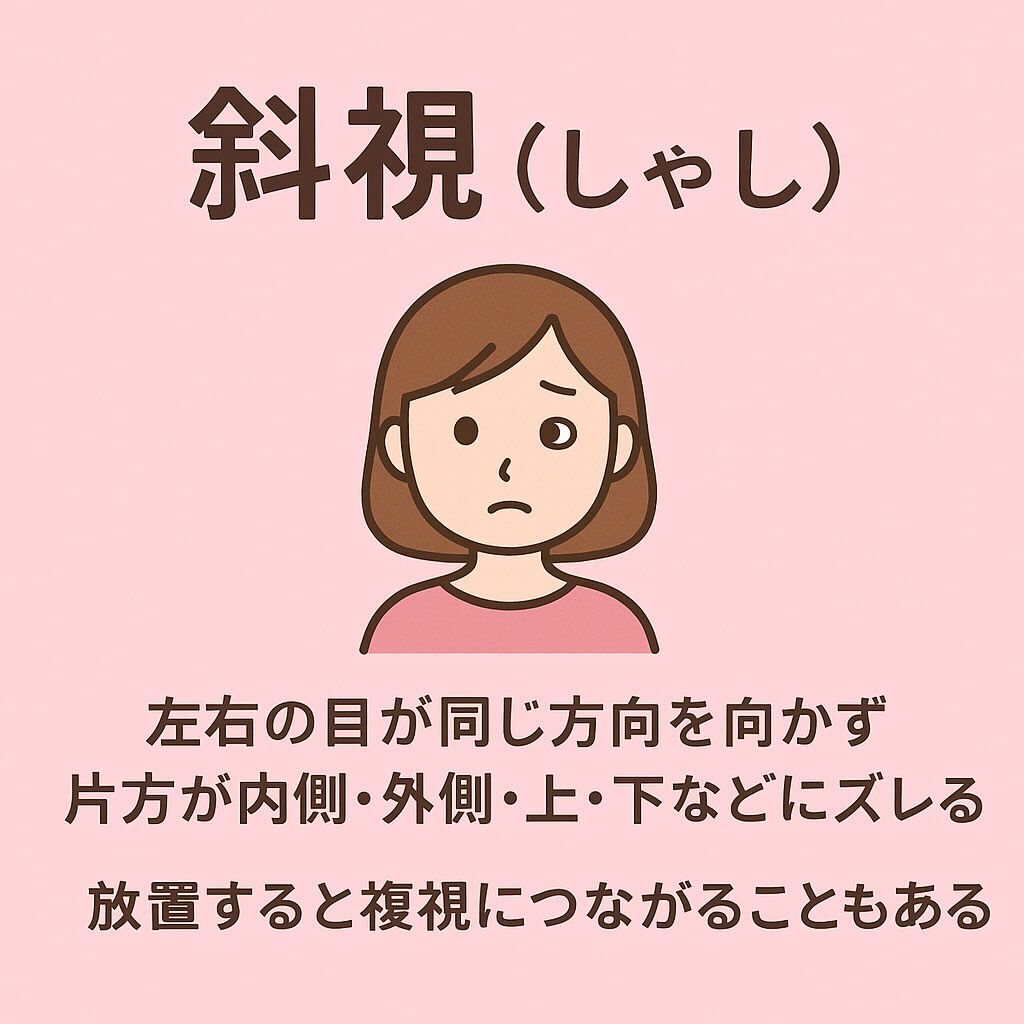 👁️ 斜視（しゃし）とは、左右の目が同じ方向を向けなくなる状